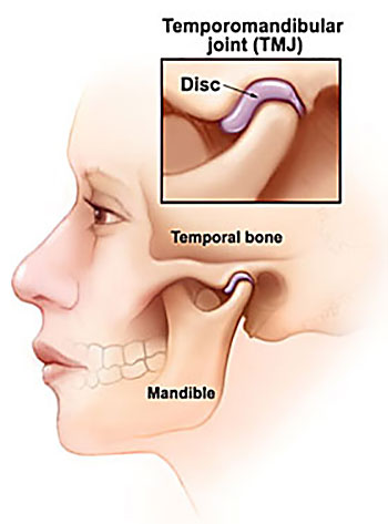 Temporomandibular Joint Disorder caused by motor vehicle accident