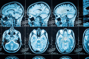 CONCUSSIONS & CAR ACCIDENTS